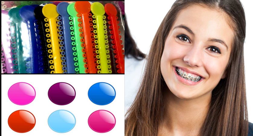 braces colors