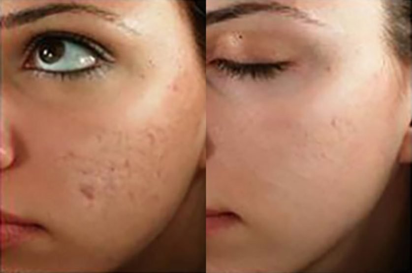 Microneedling