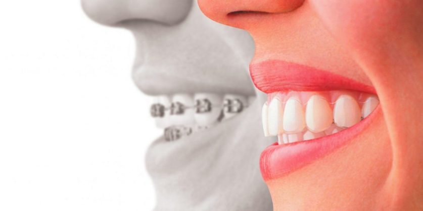 Invisalign Braces