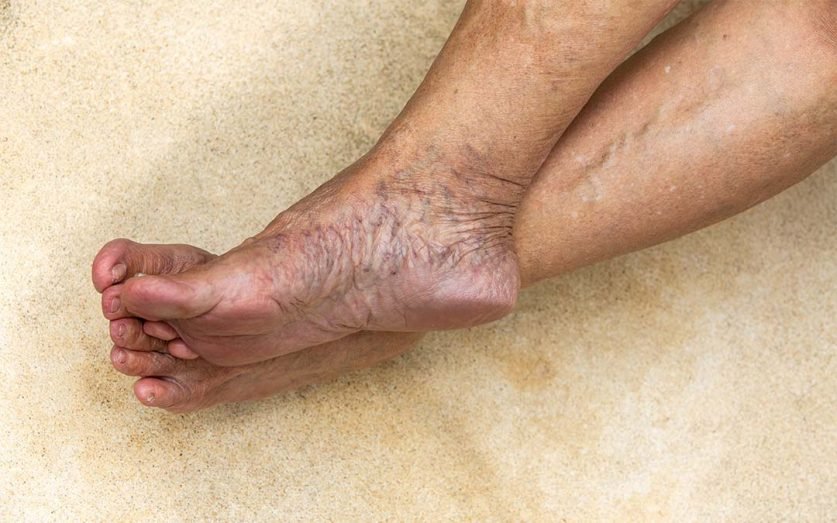 Varicose Veins