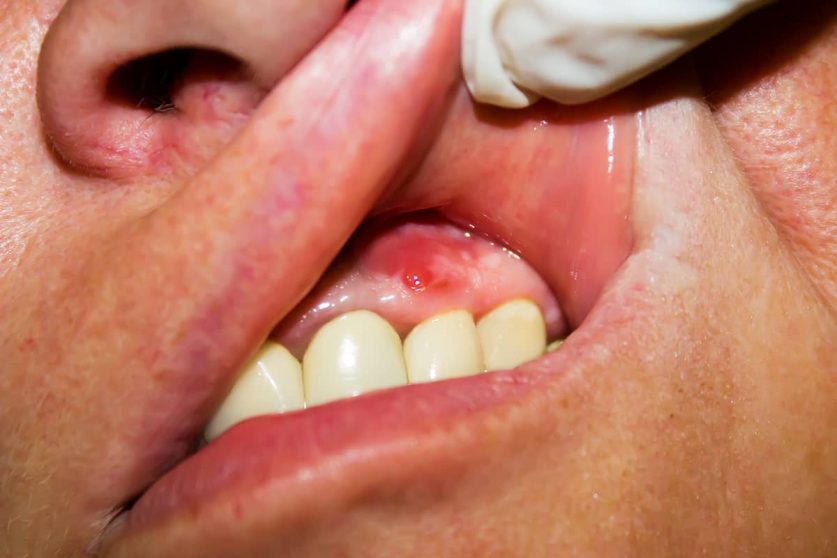 Tooth Abscesses
