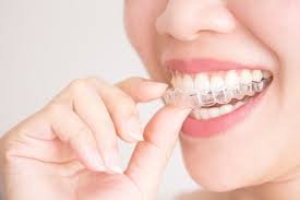 Invisalign Clear Aligners