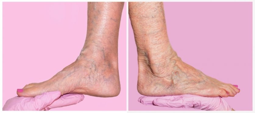 Chronic Venous Insufficiency