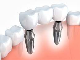 Affordable Dental Implants