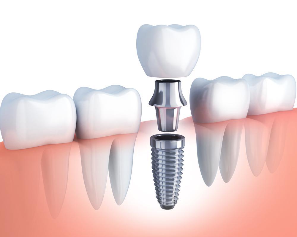 Dental Implants Texas