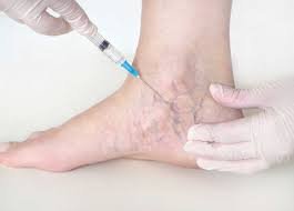 Do Spider Veins Come Back After Laser Treatment