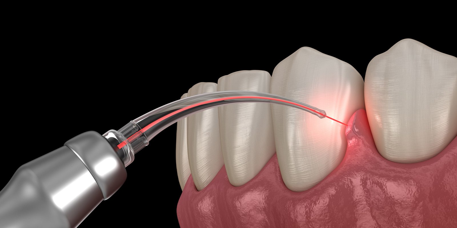 gingivitis treatment