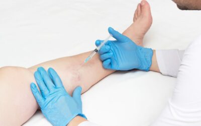 Does Spider Vein Removal Really Work?