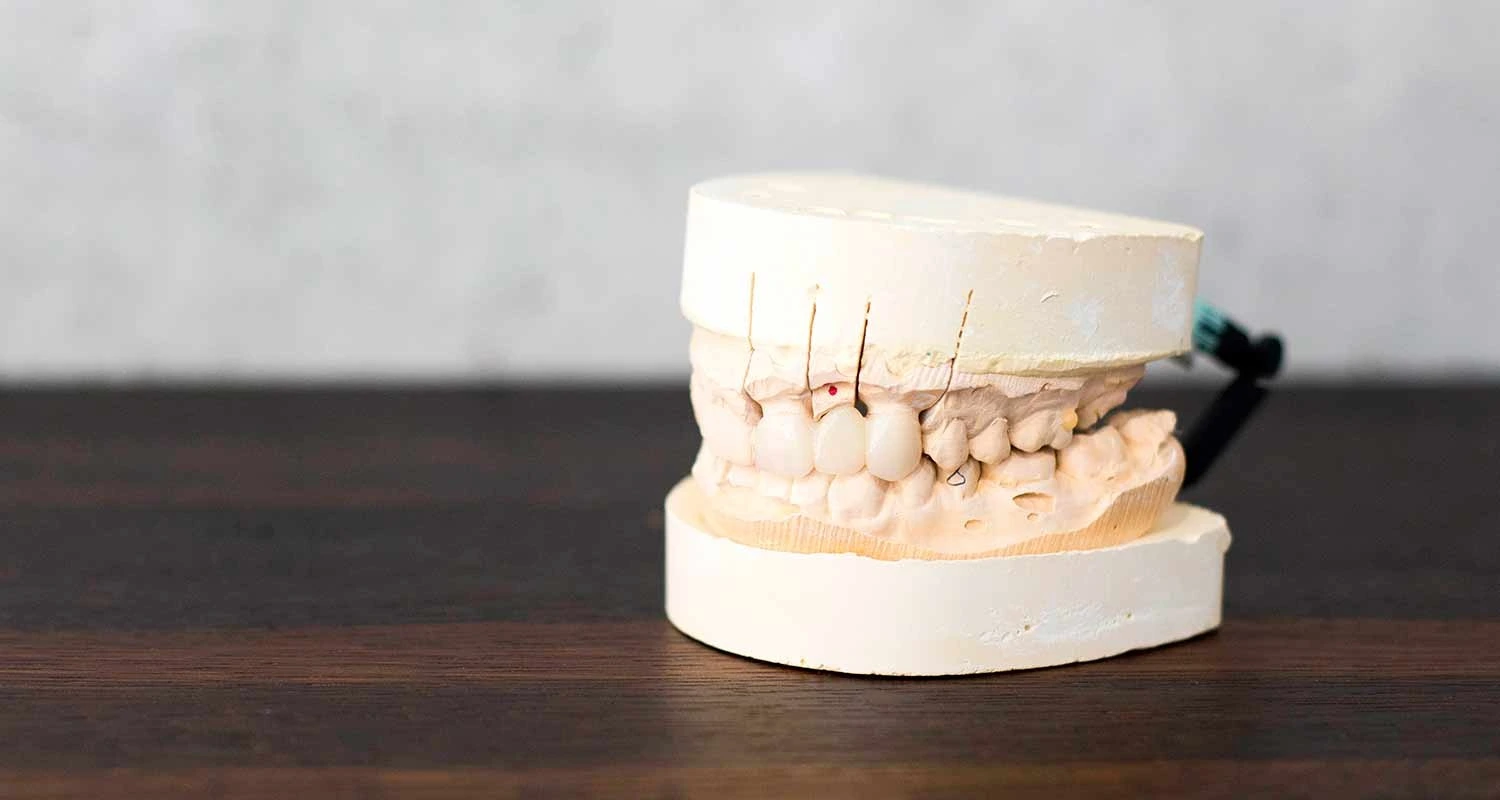 dental bridges in houston