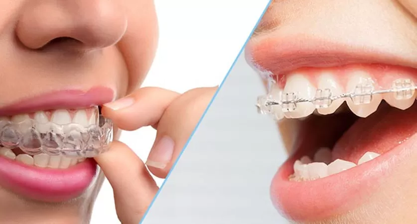 Invisalign over metal braces