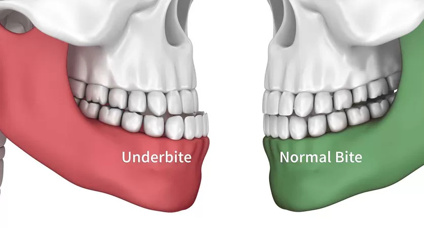 Underbite
