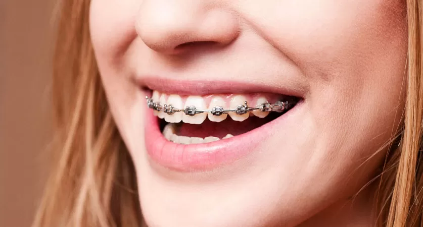 orthodontic options north Miami