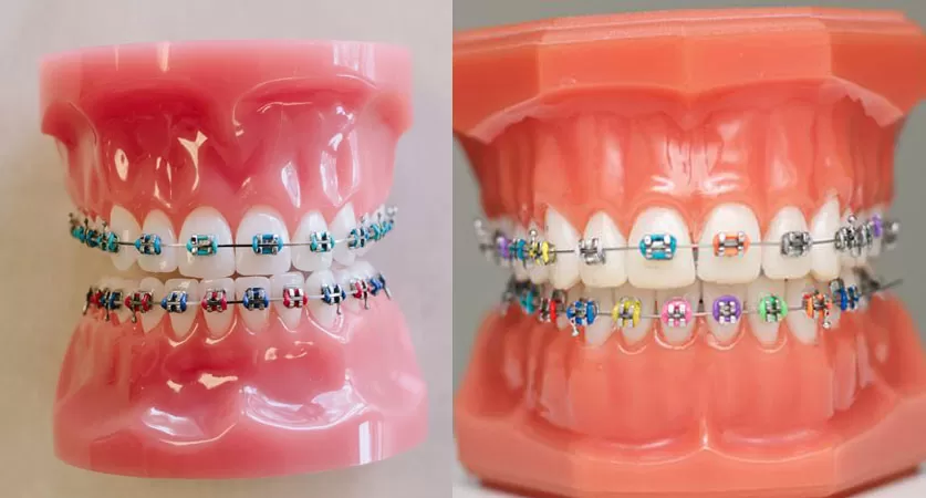 braces colors