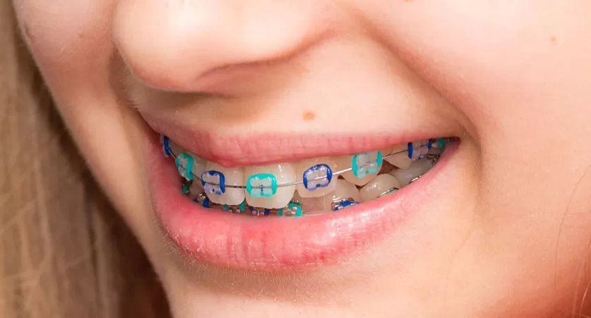 blue braces colors