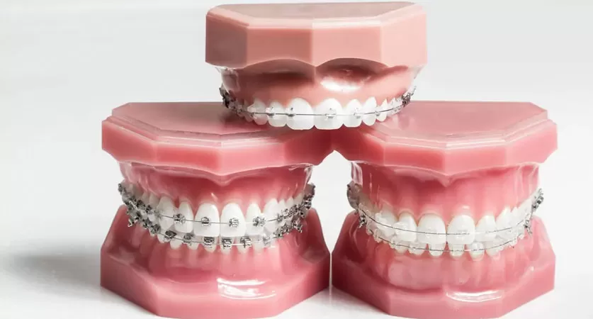 Orthodontic Treatment