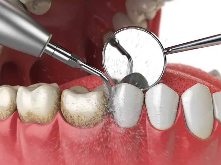 Dental Deep Cleaning