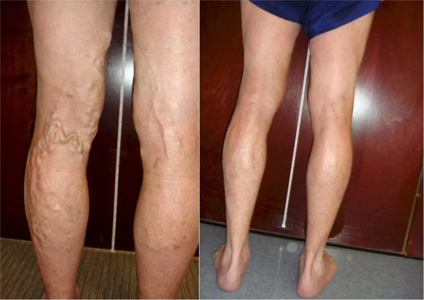 Avoid Varicose Veins