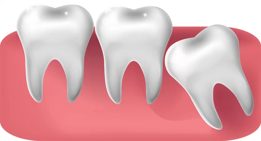 Wisdom Tooth Removal