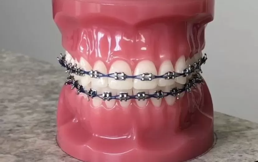 braces colors
