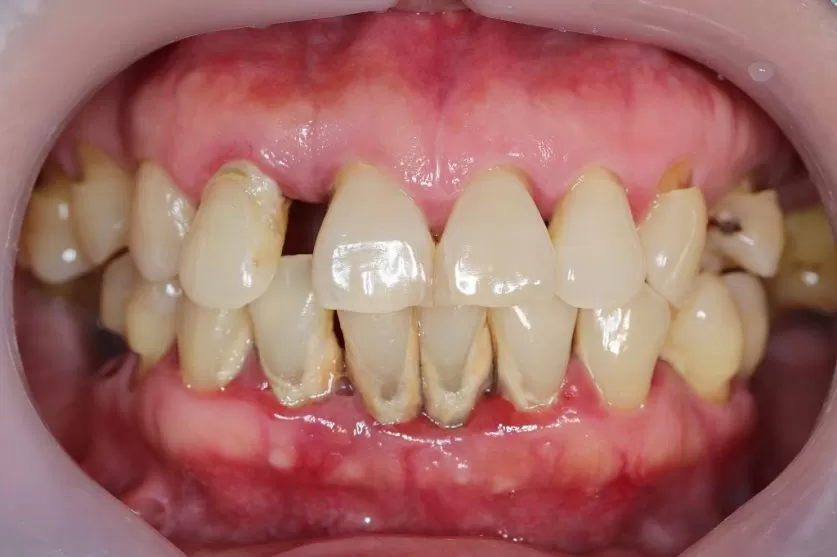 Periodontitis Disease