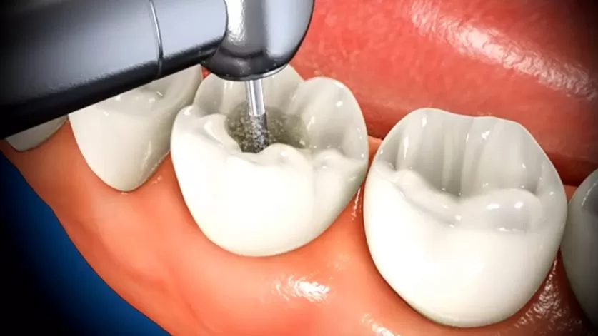 root canal specialist