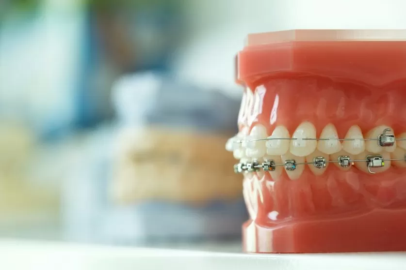 underbite