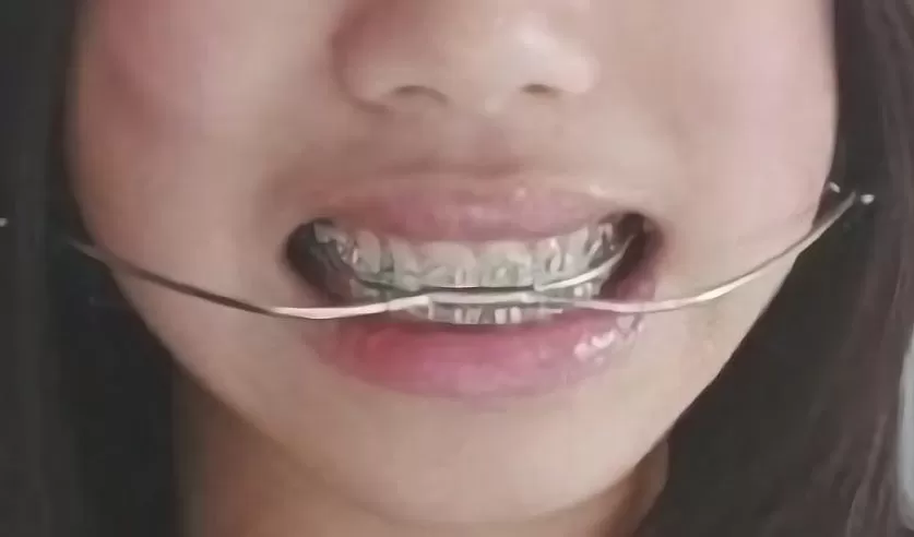 headgear braces