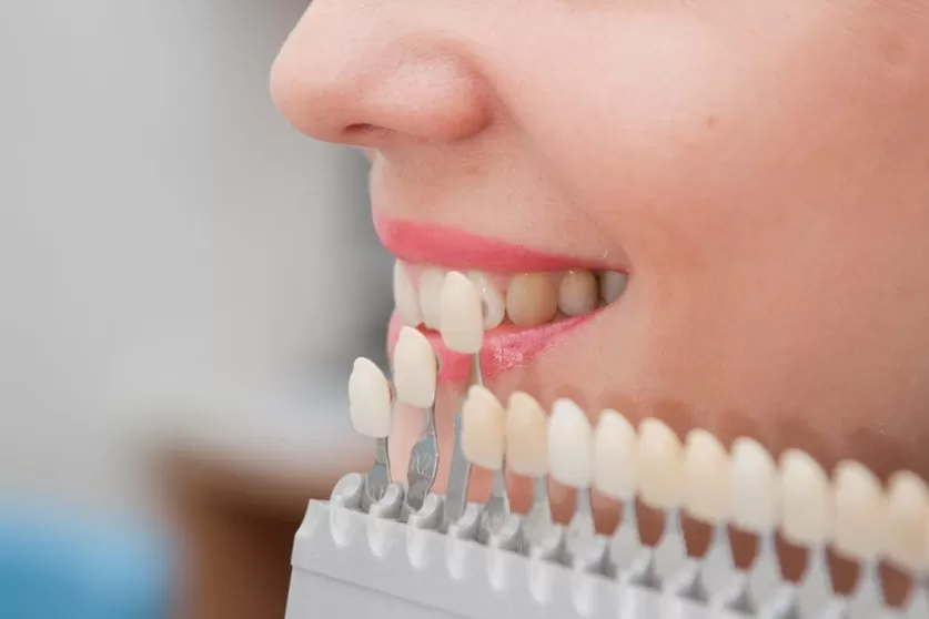 Teeth Veneers