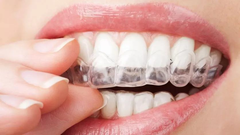 Invisalign Clear Braces