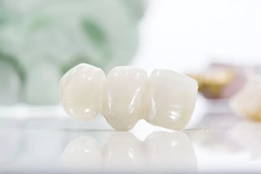 Dental Bridges