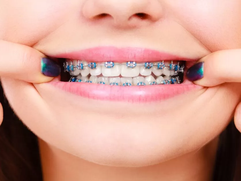 good braces colors