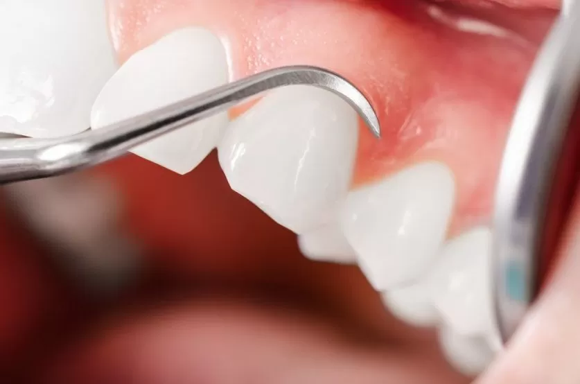 deep cleaning teeth