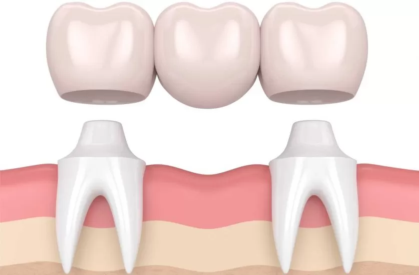 dental bridge