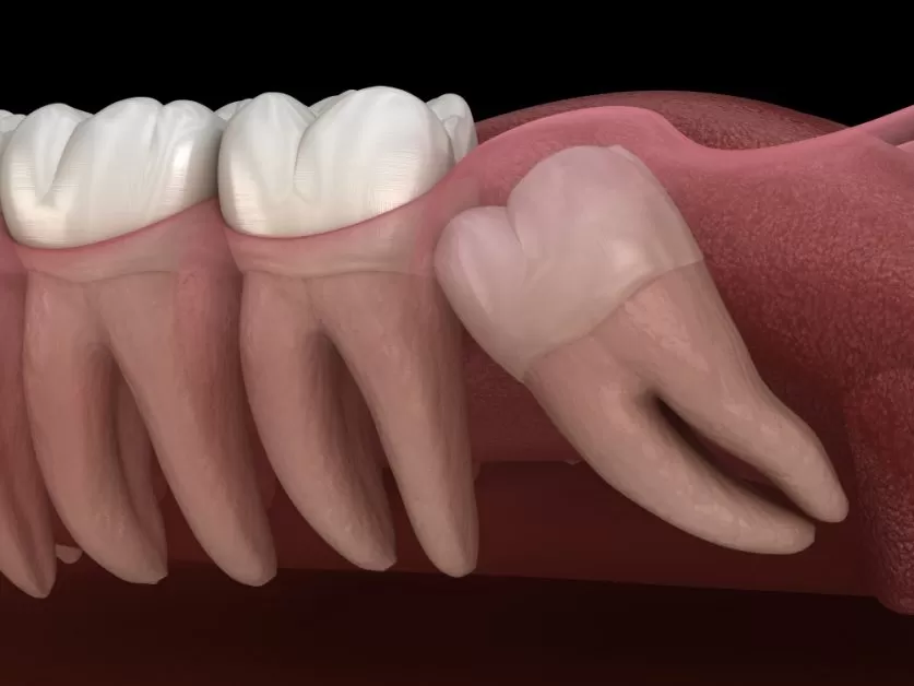 wisdom teeth removal