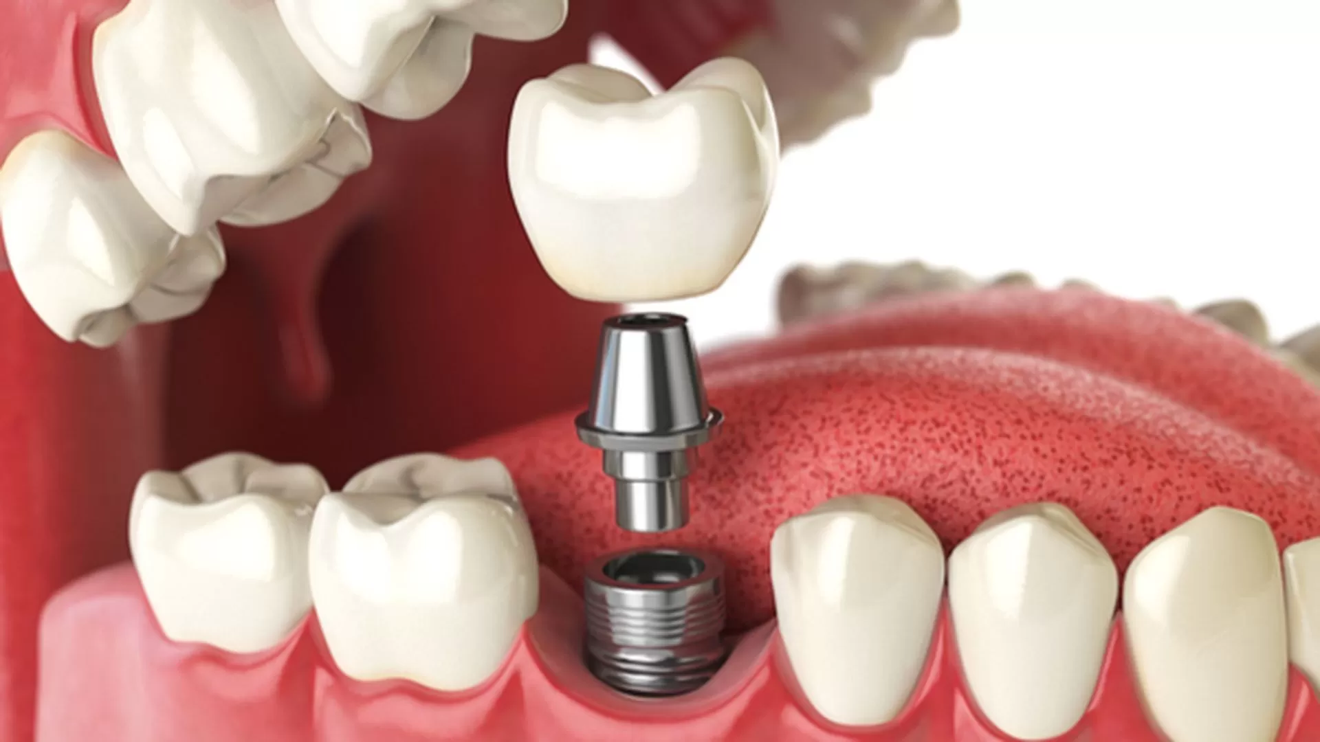 Dental Implant Surgery