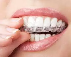 Invisalign treatment