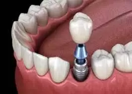 dental implants in Houston
