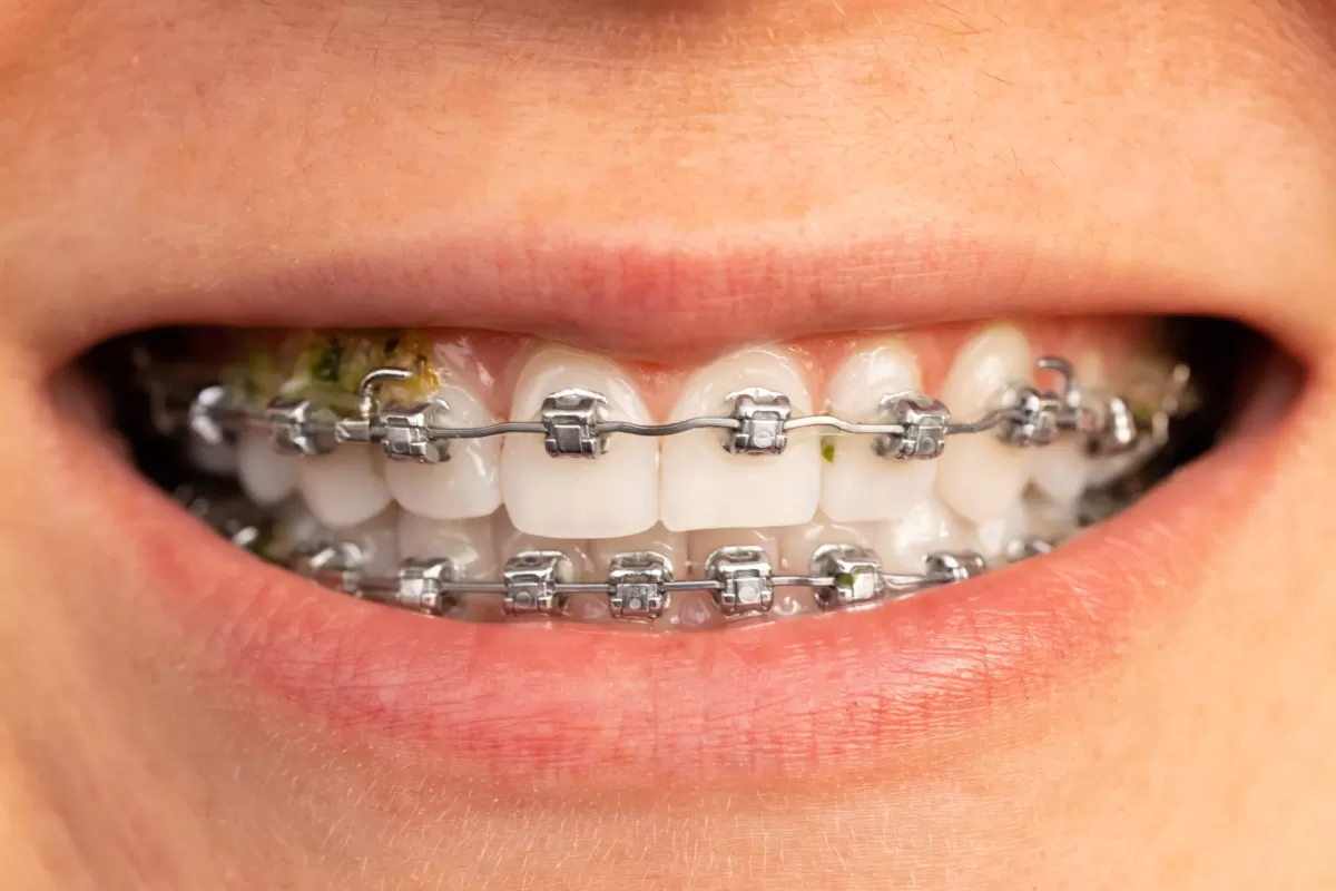 power chain braces