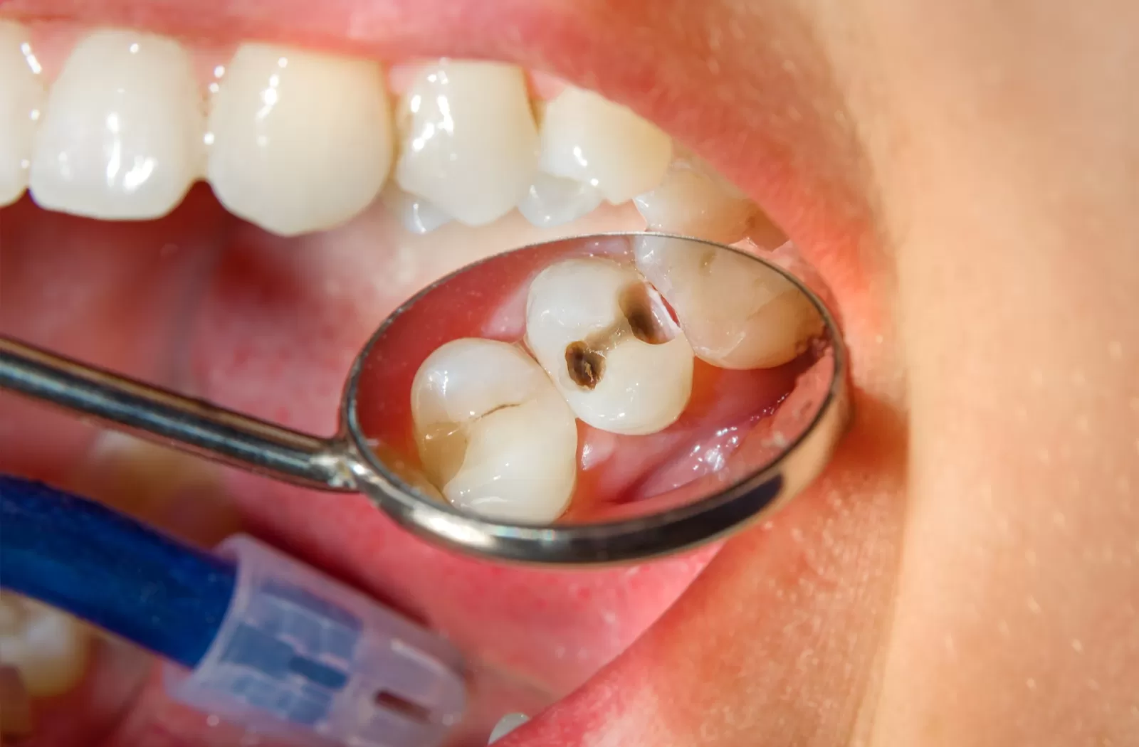 cavity removal