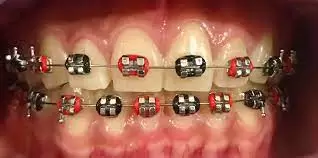 red and black braces